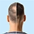 Male Pattern Baldness Treatment