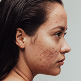Acne Treatment