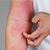 Eczema Symptoms