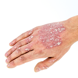 Skin Psoriasis Treatment icon