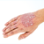 Skin Psoriasis