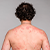 Psoriasis Symptoms icon