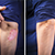 Psoriasis Treatment Result icon