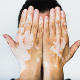 Vitiligo Symptoms icon