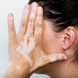 Vitiligo causes