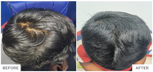 Hair Loss Treatment