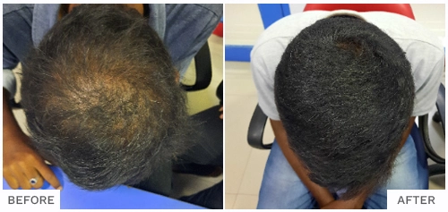 Hair Loss Treatment