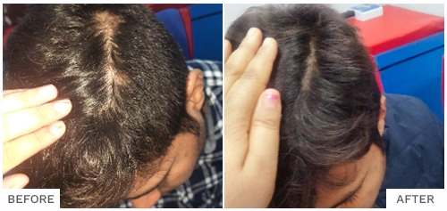 Hair Fall Treatment