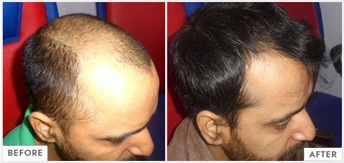 Dr Batras study Hair Loss Predicts Serious Health Problems