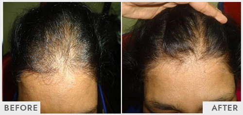 Losing Hair after Hair Transplant