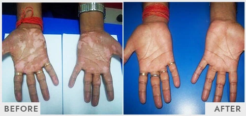 Eczema Treatment