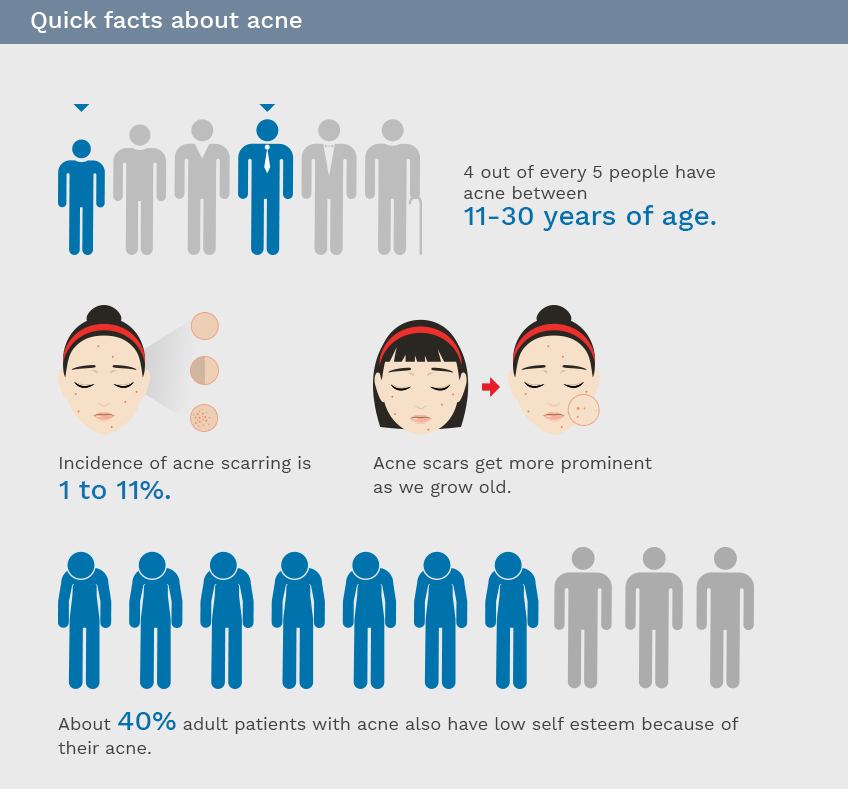 Quick Facts About Acne Facts About Acne