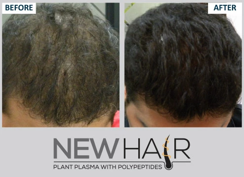 Hair Loss  Harvard Health