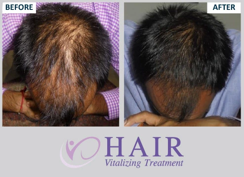 Best Homeopathic Hair Fall Treatment & Medicine for Men and Women - Dr Batra's® Best Homeopathic Hair Fall Treatment & Medicine for Men and Women - Dr Batra's®