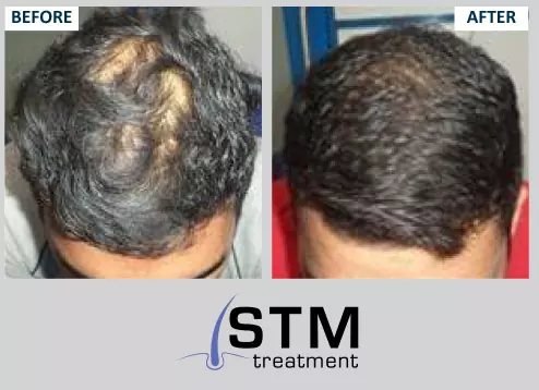 Hair Loss 10 Causes Treatments and Prevention Tips  SkinKraft