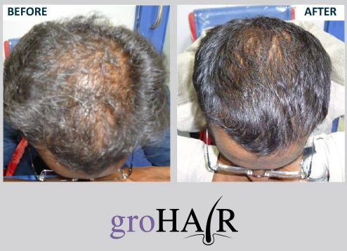 Hair Loss Alopecia Causes Symptoms and Regrowth Options