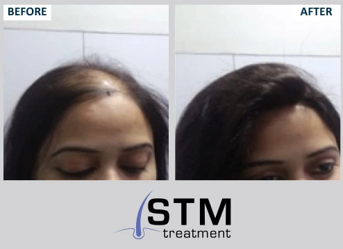 Hair Loss Treatment Services in Mumbai by Dr Batras Positive Health Clinic   ID 7223659291