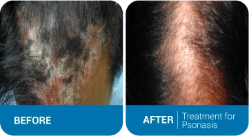Treatment for Psoriasis Results