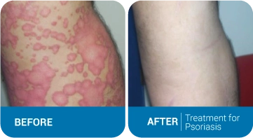Psoriasis Before After Results