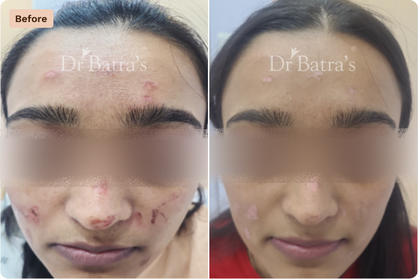 Skin Before After-3