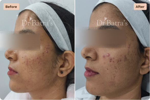 Skin Before After-4
