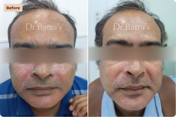 Skin Before After-6