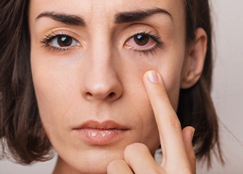 Red, watery, or irritated eyes