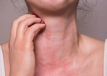 Rashes, hives, or redness