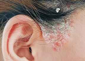 Seborrhoeic Dermatitis