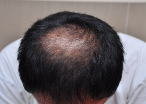 Male Pattern Baldness