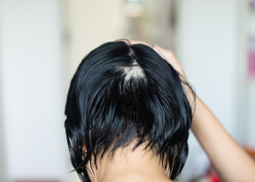 Alopecia Areata