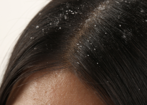 Dandruff