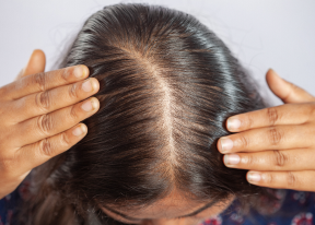Female Pattern Baldness