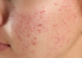 Acne