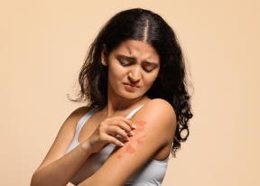 Eczema