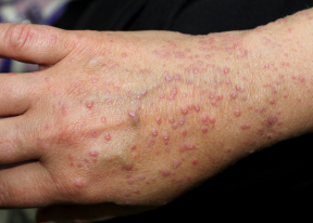 Lichen Planus