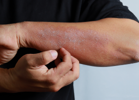 Psoriasis