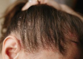 Seborrhoeic Dermatitis