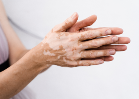 Vitiligo
