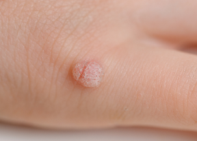 Warts