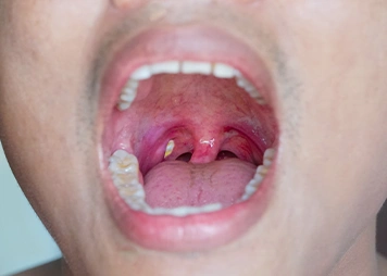 White or yellow patches on tonsils
