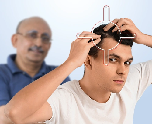 Hereditary Hair Loss Images
